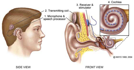 Mastoiditis surgery